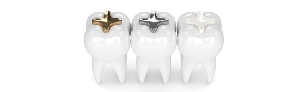 Esthetische tandvullingen bij de tandarts