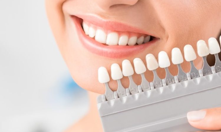 tanden bleken feature